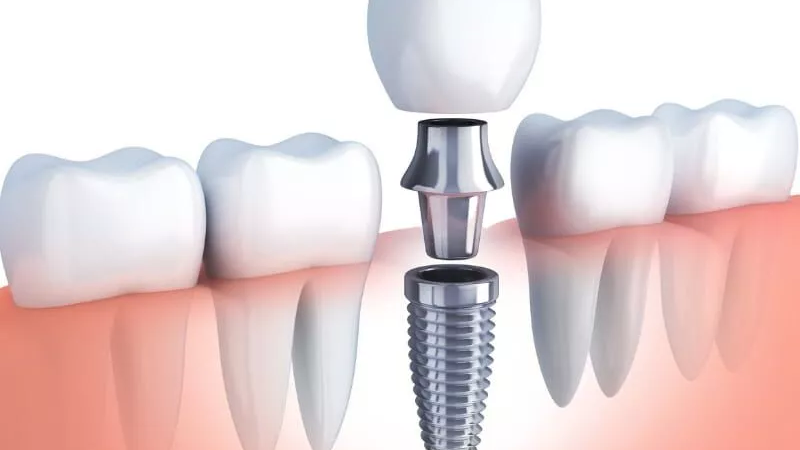 Dental Implants in Islamabad