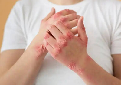 Why-Atopic-Dermatitis-Needs-More-Than-Just-Moisturizers