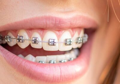 Orthodontic-Treatment