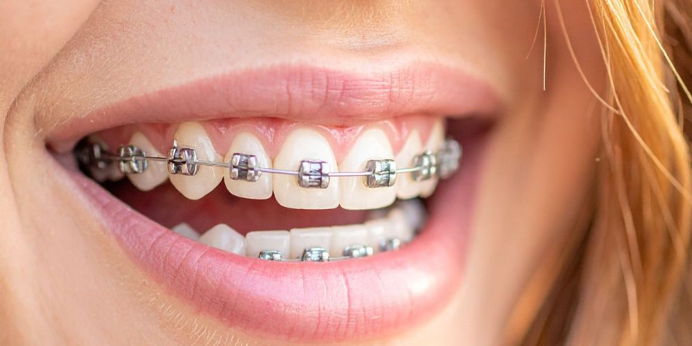 Orthodontic Treatment in Oshiwara