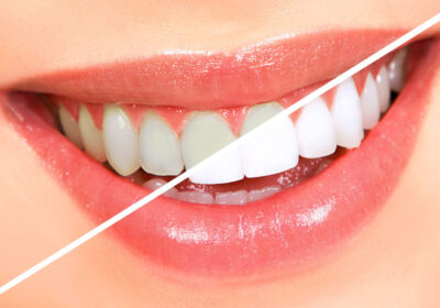 Professional-Teeth-Whitening-Services-in-North-Brunswick-Is-It-Worth-It