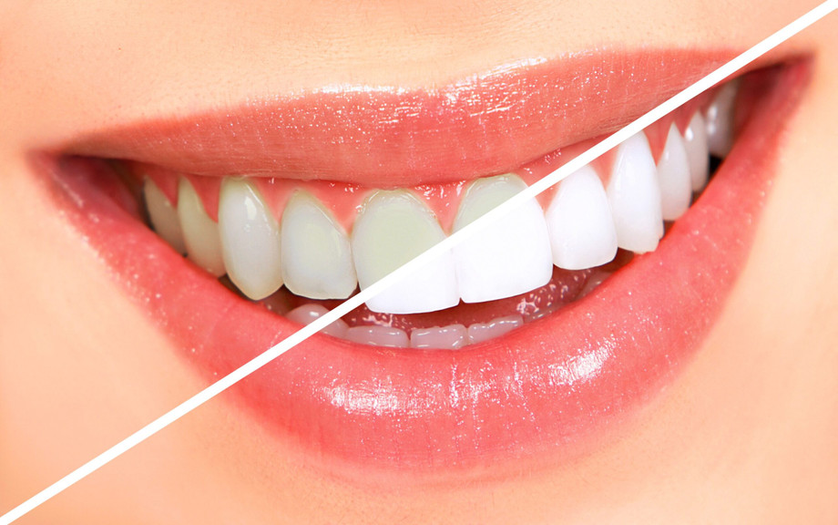 Professional Teeth Whitening Services in North Brunswick: Is It Worth It?