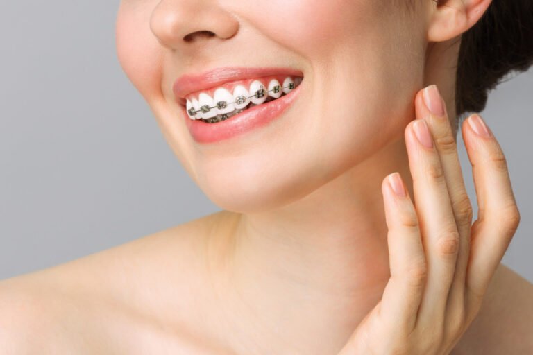 Dental Braces Treatment Cost in Bandra