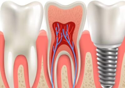 Root-canal-treatment-1