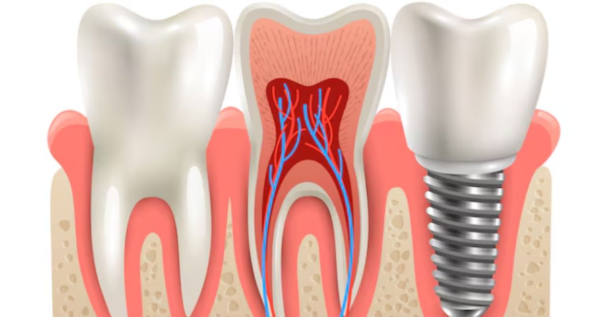 Affordable Root Canal Treatment in Fursungi