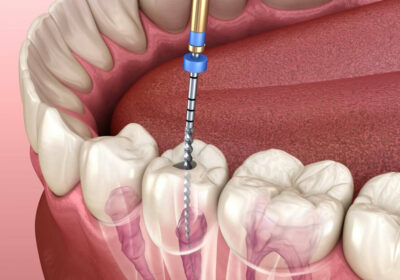Signs-You-Need-Root-Canal-Treatment-In-North-Brunswick