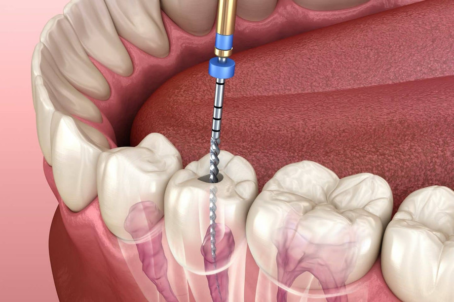 Signs You Need Root Canal Treatment In North Brunswick