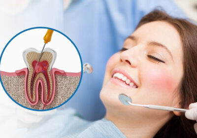 Single-Sitting-Root-Canal