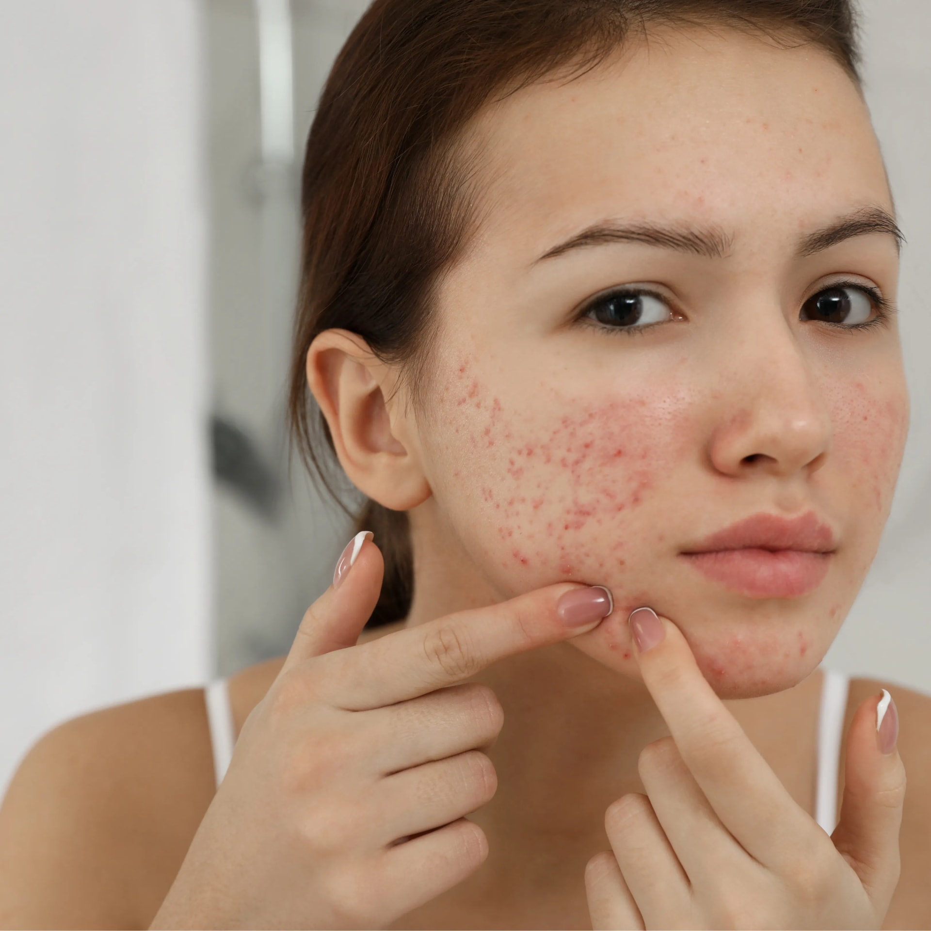 Affordable Acne Treatment Noida
