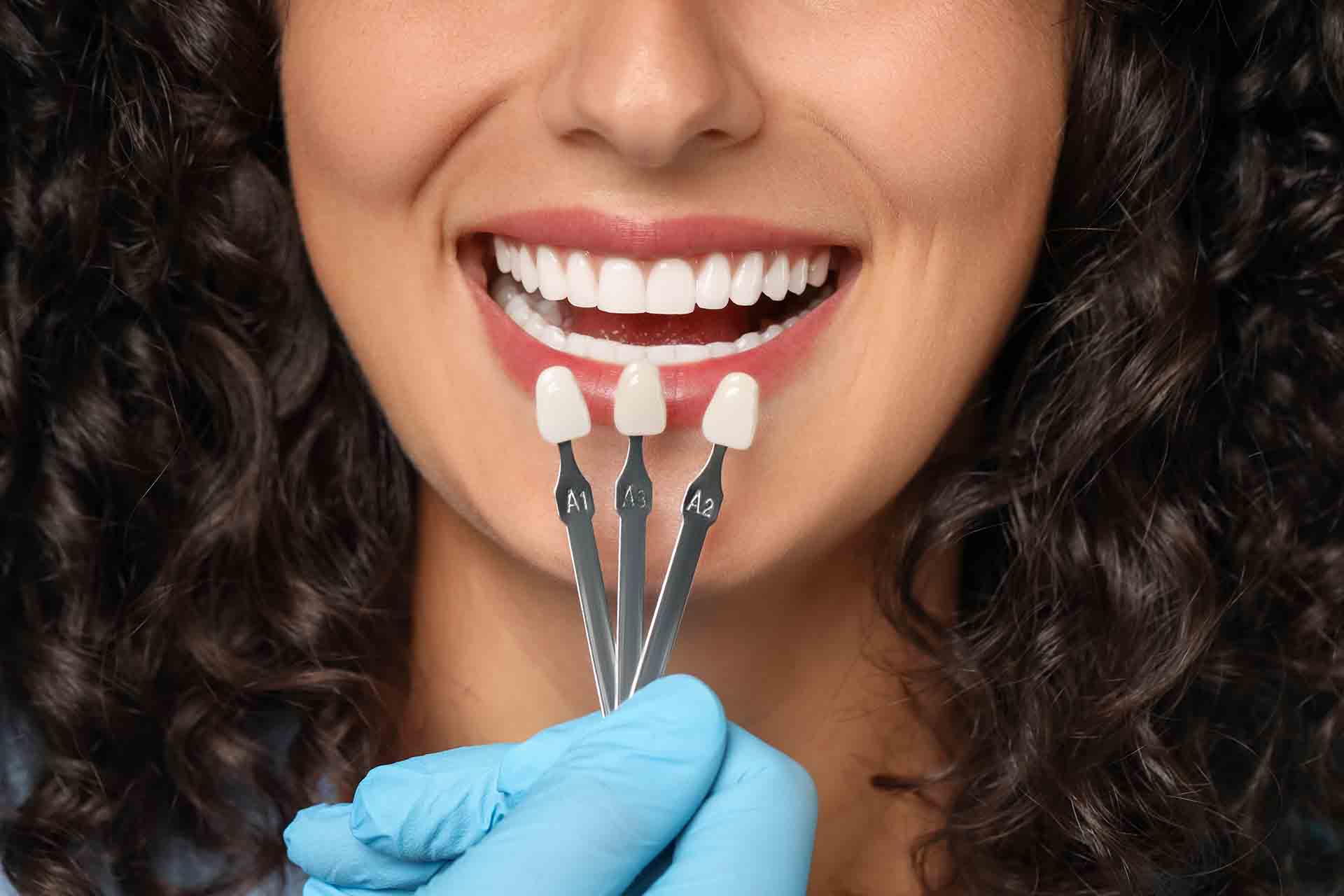 Affordable Dental Veneers Andheri West