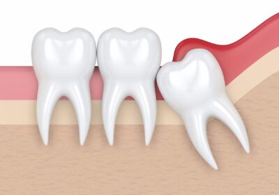 wisdom-tooth-removal