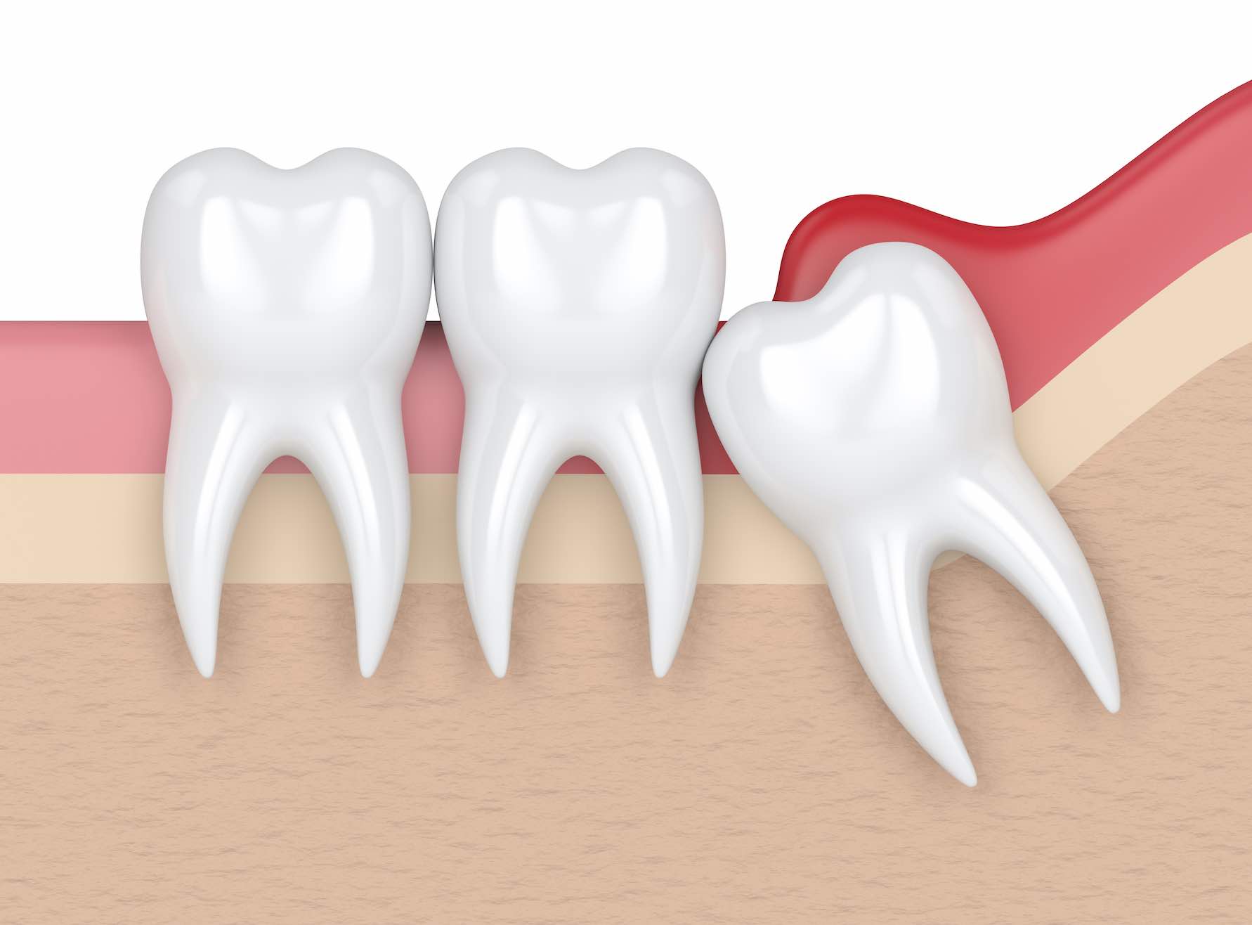 Tooth Removal in Besa