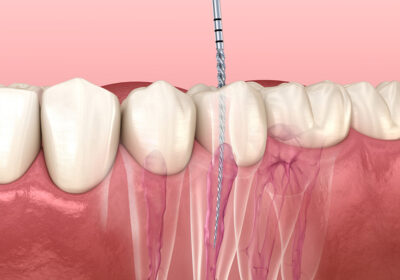 Root-Canal-vs.-Tooth-Extraction-Whats-Better-in-North-Brunswick