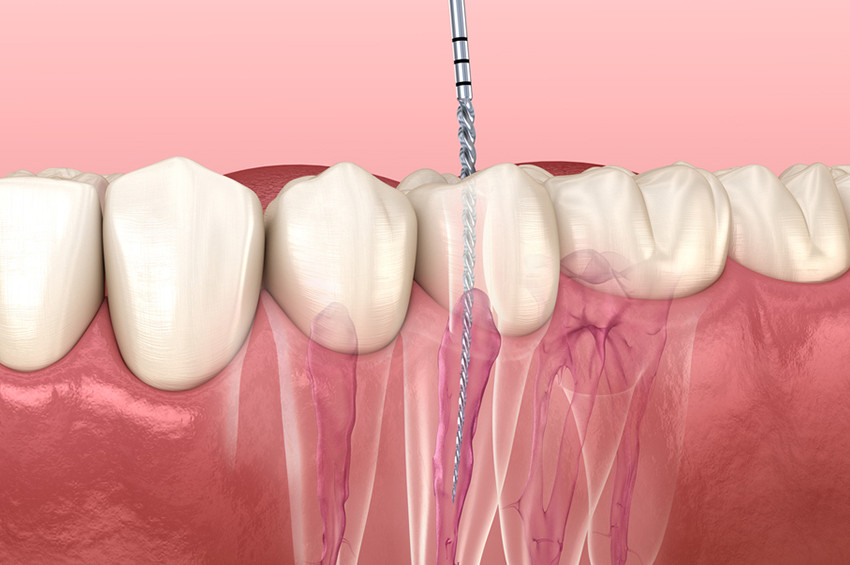 Root Canal vs. Tooth Extraction: What’s Better in North Brunswick?