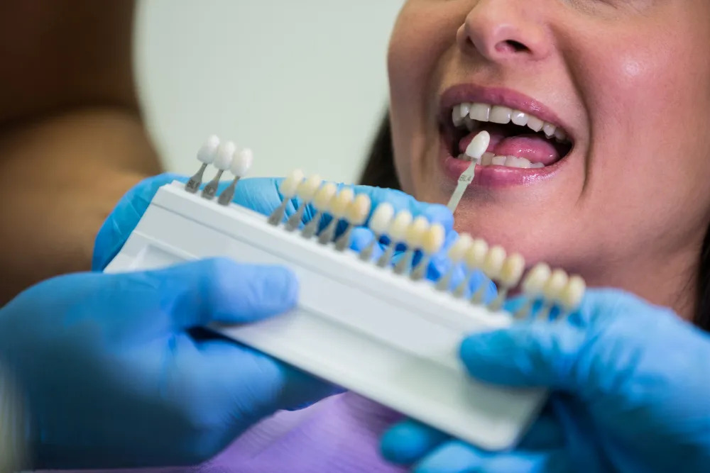Transform Your Smile with Dental Veneers – Plus Dental Clinic