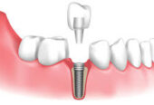 Modern Dental Implants in Encino for Complete Smile Renewal