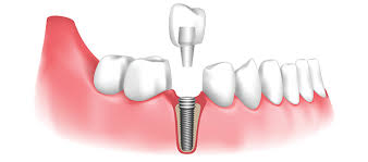 Modern Dental Implants in Encino for Complete Smile Renewal