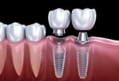 Modern Dental Implants in Encino for Complete Smile Renewal