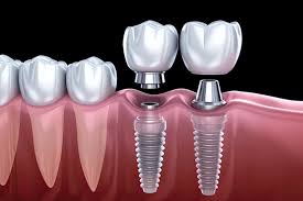 Modern Dental Implants in Encino for Complete Smile Renewal