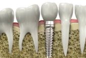 Modern Dental Implants in Encino for Complete Smile Renewal