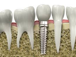 dental-implants-Encino