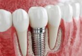 Modern Dental Implants in Encino for Complete Smile Renewal