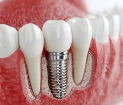 Modern Dental Implants in Encino for Complete Smile Renewal