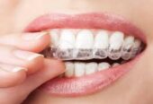 Affordable Invisalign in Century City for a Straighter Smile