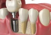 Modern Dental Implants in Encino for Complete Smile Renewal