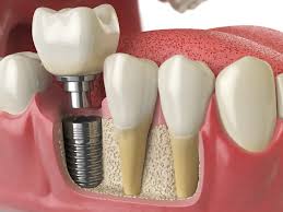 Modern Dental Implants in Encino for Complete Smile Renewal