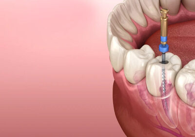 Why-Advanced-Root-Canal-Treatment-in-Thane-Is-Becoming-the-Preferred-Choice-for-Patients