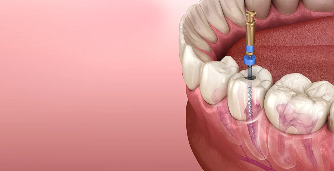 Why Advanced Root Canal Treatment in Thane Is Becoming the Preferred Choice for Patients?