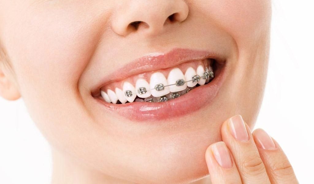 Braces Treatment in Wanowrie