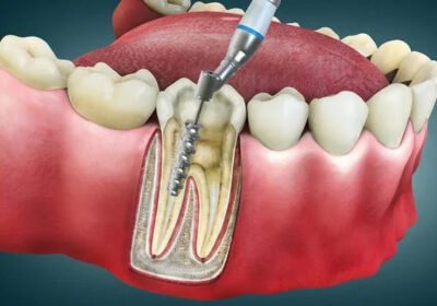 Why-Advanced-Painless-Root-Canal-Treatment-With-Microscopic-Precision-Dentistry-in-Thane-Is-Changing-Modern-Dentistry