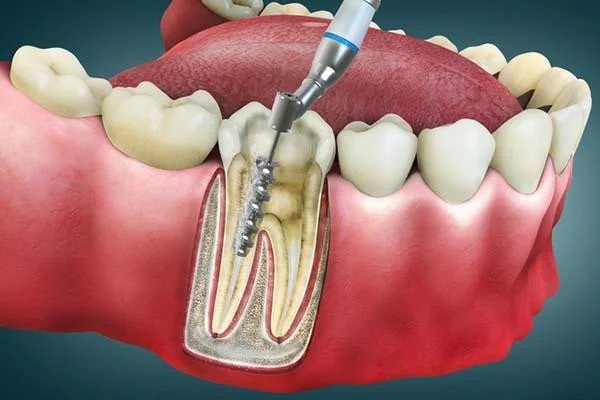 Why Advanced Painless Root Canal Treatment With Microscopic Precision Dentistry in Thane Is Changing Modern Dentistry