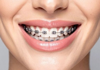 braces-treatment