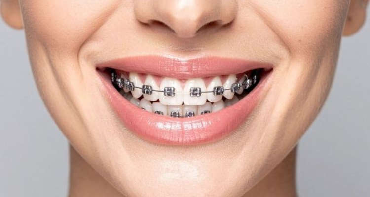 Braces Treatment in Badlapur West