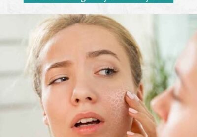 Dry-and-Flaky-Skin