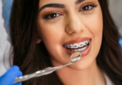 Dental-Braces
